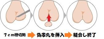 偽睾丸 西新宿杉江中央クリニック 偽睾丸 西新宿杉江中央クリニック
