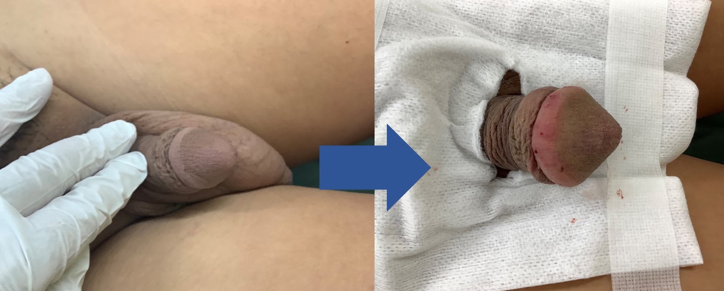 亀頭増大 アンケート 引っかかり編 西新宿杉江中央クリニック