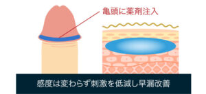 早漏治療（亀頭強化）