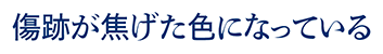 傷跡が焦げた色になっている